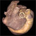 Right atrium